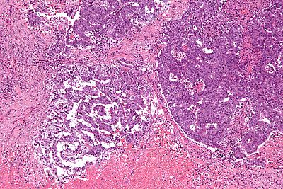 Mixed germ cell tumour - intermed mag.jpg