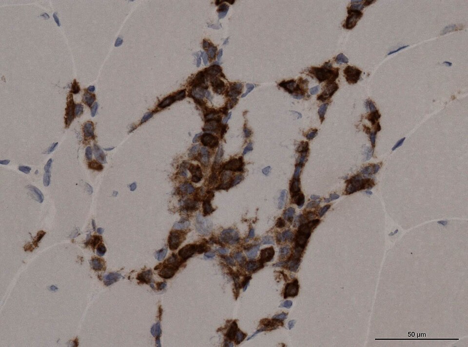 File:Neuropathology case XII 03.jpg
