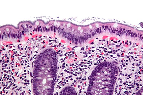 Intestinal spirochetosis - very high mag.jpg