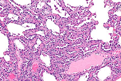 Multifocal micronodular pneumocyte hyperplasia - tuberous sclerosis - a3 -- intermed mag.jpg