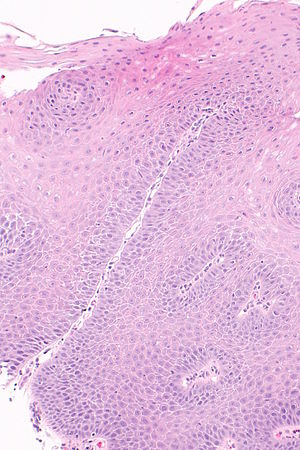 esophageal ulcer histology