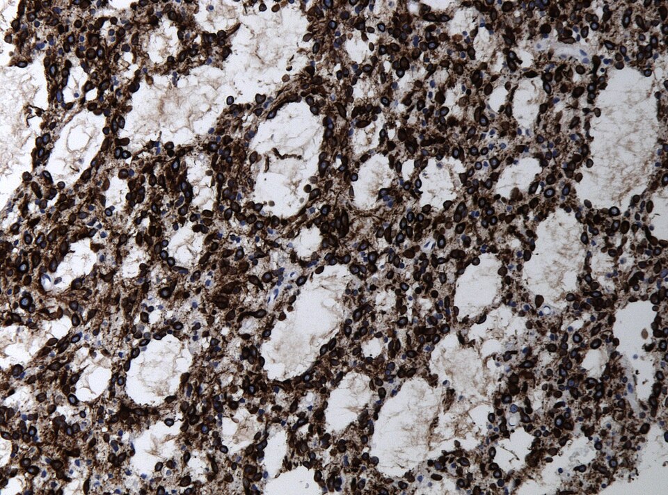 File:Neuropathology case II 07.jpg