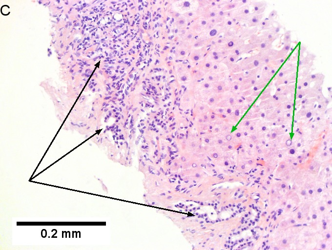 Alpha 1 anti-trypsin (A1AT) granules in cirrhosis, not due to A1AT deficiency; A1AT level was normal.