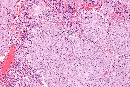 Glassy cell carcinoma - high mag.jpg