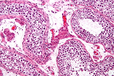 Intratubular germ cell neoplasia - high mag.jpg