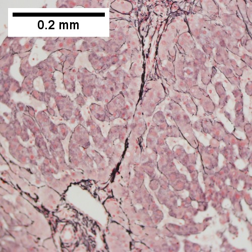Reticulin shows collapse (thick black lines) as well as a dilated portal vein (200X).