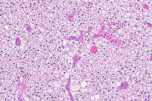 Chromophobe renal cell carcinoma -- intermed mag.jpg