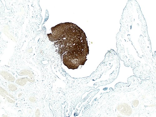 Nodular histiocytic hyperplasia in fallopian tube 4.jpg